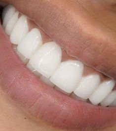 Pretty Teeth, Crest 3d White, Whiter Teeth, Whiten Your Teeth, Perfect Teeth, Whitening Kit, Teeth Whitening Kit, Oral Health Care, White Teeth