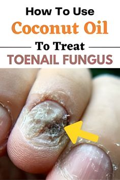 How to use COOCNUT Oil to treat TOENAIL FUNGUS!!! Fungal Infection Remedies, Toenail Health, Toenail Fungal Infection, Fingernail Fungus, Toenail Fungus Remedies, Nail Fungus Remedy, Fungal Nail, Homemade Oil, Nail Care Routine