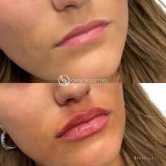 Lip Injection Before & After Gallery | OMNI SCULPT MD Lip Injections, Lip Fillers, Dallas Tx, Dallas, Look At, Lips