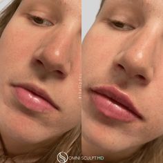 Lip Injection Before & After Gallery | OMNI SCULPT MD Lip Filler, 13k Followers, Med Spa, Luxury Boutique, Anti Aging