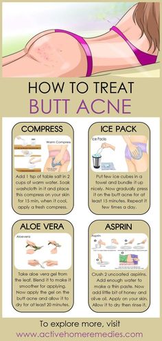 How to Treat Butt Acne Naturally #acne #buttacne #homeremedies #naturalbeauty #howto Forehead Acne, Acne Remedies, How To Get Rid Of Acne, Skin Care Remedies, Body Skin Care Routine, Diy Skin Care, Diy Skin, How To Treat Acne, Face Skin Care