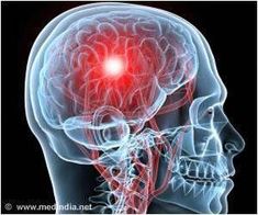 A new study has found that treating patients who suffer from a common condition that affects blood vessels in the brain increases their risk of stroke. Craniosacral Therapy, Brain Tissue, Mental Disorders, Central Nervous System, Brain Fog, Human Brain, Neurology, The Human Body, Brain Health