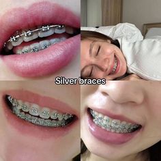 Perfect Teeth Braces, Silver Braces, Cute Braces Colors, Teeth Aesthetic, Braces Tips, Getting Braces, Braces Girls, Cute Braces