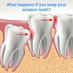 Wisdom Tooth Removal, Impacted Wisdom Teeth, Wisdom Teeth Pain, Impacted Tooth, Temporary Tooth, Wisdom Tooth, Wisdom Tooth Extraction, Protein Oatmeal, Loose Tooth