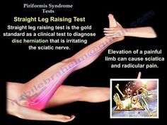 Piriformis Test - Everything You Need To Know - Dr. Nabil Ebraheim - YouTube Piriformis Syndrome Exercises, Spine Problems, Psoas Release, Bursitis Hip, Piriformis Muscle, Meridian Massage, Piriformis Stretch, Disk Herniation, Hip Problems