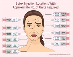 Botox Pre And Post Care, Best Botox Injection Sites, Diy Botox Injections, Botox Units Needed, After Botox Care, Botox Face Mapping, How Many Units Of Botox Do I Need, Cosmetic Injectables Aesthetic, Botox Brow Lift Injection Site