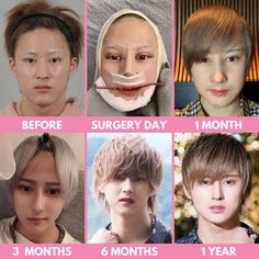 #plasticsurgery #plasticsurgerygonewrong #beforeafter #celebritiesbeforeafter #hollywoodstars #bignosesurgery #surgery #facesurgery #vlinesurgery #koreanplasticsurgery #kpopplasticsurgery #nosejob #jawreductionsurgery #eyesurgery #cheekfillers #rhinoplasty #facelift #plasticsurgeryfails #expensiveplasticsurgery Facial Contouring Surgery, Cheekbone Reduction, Kpop Plastic Surgery, V Line Surgery, Plastic Surgery Korea, V Shape Face