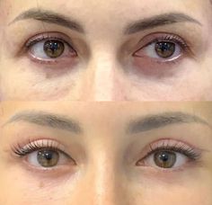 Plastic Surgery Transformation, Almond Eye Surgery, Cat Eye Surgery, Upper Blephoraplasty, Blephoraplasty Surgery, Upper Blephoraplasty Before And After, Blephoraplasty Before And After, Plastic Surgery Before And After, Eye Lift Surgery