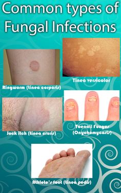 Tinea Corporis, Tinea Versicolor, Toenail Fungal Infection, Fungal Infection Skin, Toenail Fungus Remedies, Natural Antibiotics, Toenail Fungus, Skin Disorders