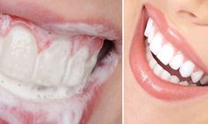 Magnesium Deficiency, Teeth Health, Teeth Care, White Teeth, Healthy Teeth