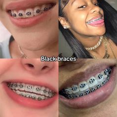 Black Braces Color, Black Braces Aesthetic, Black Braces Teeth, Burgundy Braces, Braces Colours, Braces Colors Combinations