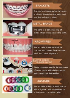 Parts of your braces :) Brace Tips, Braces Hacks, Invisible Teeth Braces, Scarborough Toronto, Zoom Whitening, Braces Bands, Scarborough Ontario, Dental Assistant Study, Types Of Braces