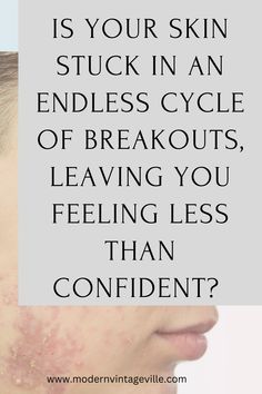 Are you tired of battling stubborn acne that leaves scars on both your skin and confidence? 

Imagine waking up to a clear, glowing face that's ready to take on the world without a hint of insecurity. 

I DO understand the struggles, the endless piles of products promising perfect skin but yielding no results. 

It’s time for a change. 

Let's see if your skincare routing is actually hurting your skin and causing acne Stubborn Acne, Glowing Face, Perfect Skin, Korean Skincare, Damaged Skin, Your Skin, How Are You Feeling