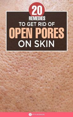 Open Pores On Face, Pores On Face, Lotion For Oily Skin, Home Remedies For Skin, Open Pores, Baking Soda Shampoo, Moisturizer For Oily Skin, Large Pores