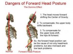 Posture Fix, Throbbing Headache, Text Neck, Neck And Back Pain, Back Pain Exercises, Poor Posture