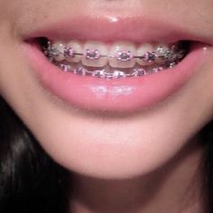 Lingual Braces, Braces Bands, Kids Braces, Braces Girls