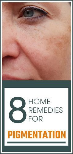 Uneven Skin Tone Remedies, Brown Age Spots, Homemade Face Cream, Get Rid Of Warts, Brown Spots Removal