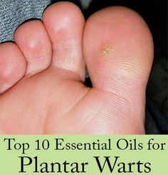 Find out the best essential oils to use for plantar warts and recipes that work Natural Wart Remover, Plantar Warts, Types Of Warts, Oregano Oil Benefits, Warts On Hands, Oils For Dandruff, Tea Tree Oil For Acne, Good Recipe