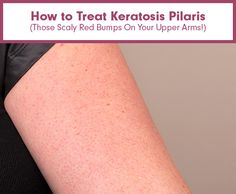 How to Treat Keratosis Pilaris (Those Scaly Red Bumps On Your Upper Arms!) All Things Girly, One And Done, Upper Arms, Savannah Georgia, Homemade Beauty Products, Beauty Routine