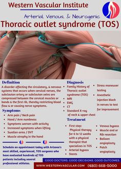 Thoracic Outlet Syndrome (TOS) | Arizona's Leading Vascular Surgery Group Subclavian Artery, Vascular Surgery, Spine Health, Tennis Elbow, Medical Anatomy, Hand Therapy, Ehlers Danlos Syndrome, Sciatic Nerve