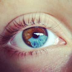 Sectoral heterochromia Sectoral Heterochromia, Heterochromia Iridum, Heterochromia Eyes, Kat Diy, Beautiful Eyes Color, Different Colored Eyes, Parts Of The Eye, Aesthetic Eyes