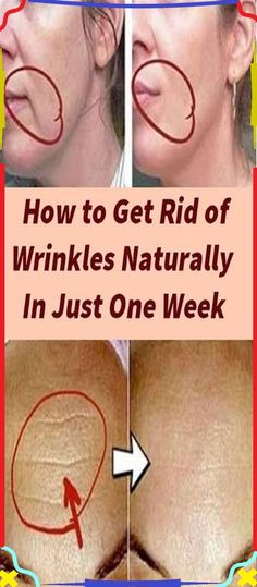 Get Rid Of Wrinkles, Erase Wrinkles, Eye Exercises, Skin Care Wrinkles, Face Wrinkles, Wrinkle Cream, Health And Beauty Tips, Aging Skin Care