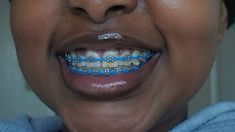 Braces Royal Blue, Power Chain Braces Colors, Braces Colors Black, Dark Purple Braces, Braces Power Chain, Pretty Braces Colors