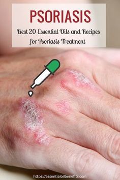 Home Remedies For Warts, Warts Remedy, Essential Oil Benefits, Doterra Oils, Oil Benefits, Best Essential Oils, Essential Oil Uses, Doterra Essential Oils, Essential Oil Recipes