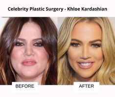 Kylie Before Surgery, Plastic Surgery Pictures