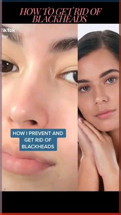 Struggling with stubborn blackheads? Discover the best home remedies to get rid of blackheads and achieve clear, smooth skin! From baking soda scrubs to DIY masks and preventive tips, this guide covers everything you need to know to banish blackheads for good. Perfect for a natural skincare routine that really works! 🧖‍♀️✨ Click to learn the secrets to blackhead-free skin! #BlackheadRemoval #SkincareTips #ClearSkin Skincare For Blackheads, Smooth Skin Remedies, Blackheads On Cheeks, Facial Peels, Clear Smooth Skin, Soothing Face Mask, Blackheads On Face, Natural Skincare Routine, Blackheads On Nose