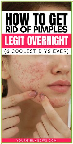 Remedies For Pimples, Get Rid Of Pimples Overnight, Rid Of Pimples Overnight, Home Remedies For Pimples, Get Rid Of Pimples, Rid Of Pimples, Pimples Overnight, Pimples Remedies, How To Get Rid Of Pimples