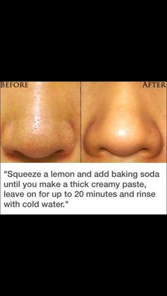 Jus Lemon, Blackhead Remedies, Black Heads, Get Rid Of Blackheads, Beauty Remedies, Acne Remedies, Skin Pores, Trening Pilates, Homemade Beauty Products