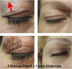 Eye Lift Surgery, Skin Anatomy, Code Barre, Skin Needling, Droopy Eyelids, Eyelid Lift