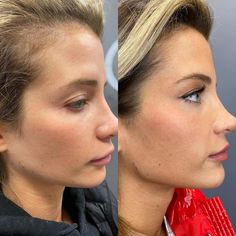 The Southern Charm alum opened up about her decision to get dermal filler on Instagram Jaw And Cheek Filler, Chin And Cheek Fillers, Naomi Southern Charm Hair, Naomi Olindo Style, Chin Enhancement Before After, Naomie Olindo Hair, Chin Implants Before And After, Jaw And Chin Filler Before And After, Cheek And Chin Fillers Before After