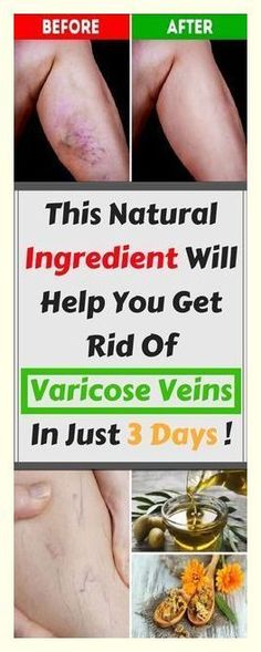 Varicose Vein Removal, Varicose Vein Remedy, Vein Removal, Color Psychology, Natural Home Remedies, Health Matters, Good Night Quotes, Health Remedies, Natural Healing