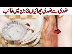 Pigmentation Removal Remedies, Remove Pigmentation From Face, Pigmentation Remedy, Freckle Remover, Baking Soda Toothpaste, Pakistan Day, Hair Without Heat, Get Clear Skin