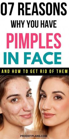 Pimple Remedies, Pimples On Scalp, Face Pimples, To Remove Pimples