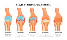 Rheumatoid Arthritis Stages Infographics Back Pain Remedies, Postpartum Support, Health Screening, Preventative Health, Healthy Joints, Chronic Inflammation, Health Life, Low Impact Workout