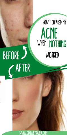 Looking for an acne face wash that actually works? Check this pharmacist Guide on the best acne face wash acne face wash, acne face wash best, acne face wash for sensitive skin, face wash for acne prone skin, face wash for acne, face wash for acne and oily skin, cleanser for acne, acne skincare routine, how to treat acne at home, salicylic acid cleanser, face wash for cystic acne, Face Wash For Oily Skin Acne