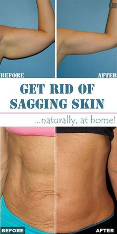 Tighten Stomach, Home Remedies For Skin, Tighten Loose Skin, Crepey Skin, Saggy Skin, Skin Remedies, Loose Skin, Sagging Skin, Skin Tightening