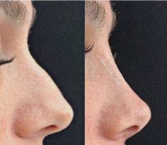 Nose Job Inspiration Rhinoplasty, Ideal Nose Rhinoplasty, Desired Nose, Nose Fillers, Brown Eyes Aesthetic, Rhinoplasty Nose Jobs, Wax Roller, Job Inspiration, Pretty Nose