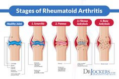 Rheumatoid Diet, Chronic Inflammation Remedies, Ra Diet, Med Surge, Ra Symptoms, Autoimmune Disease Symptoms, Inflammation Remedies, Synovial Fluid