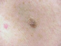 What is Seborrheic Keratosis Seborrheic keratoses are raised developments on the skin. Seborrheic means greasy and keratosis means thickening of the skin. There might be only one or bunches of handfuls. Seborrheic keratoses are normally started off light tan, and after that may darken to dark brown or about black. They might be oval spots… Seborrheic Keratosis, Skin Growths, Brown Spots Removal, Home Health Remedies, Natural Health Remedies, Brown Spots, Natural Herbs