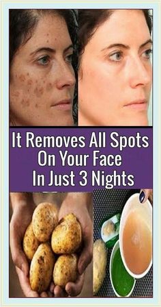 This 2-Ingredient Remedy Removes All Spots From Your Face in Just 3 Nights Bleaching Your Skin, Brown Spots On Skin, Dark Spots On Face, Brown Spots Removal, Brown Spots On Face, Dark Spots On Skin, Skin Spots, Spots On Face, Remove Dark Spots