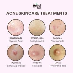 Active Acne Remedies, Dry And Acne Prone Skin, Fungal Acne Remedies, Acne Breakout Chart, Breakout Map Face, Face Problems Skin, Acne Around Mouth And Chin, Skin Care For Sensitive Acne Prone Skin, Acne Placement