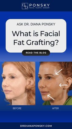 Facial fat grafting is a cosmetic surgical procedure that combats aging by bringing volume back to areas of your face via autologous fat transfer. This is a good option for those who are not ready for a more invasive facelift or less permanent hyaluronic acid fillers.  Facial fat transfer is more “natural” because it uses the patient’s own fat so there is no risk of rejection.  Fat injections act as the natural facial filler to improve facial contours and create significant facial rejuvenation. #facialrejuvenation #fatgrafting #fattransfer #clevelandplasticsurgery Facial Fat Grafting, Fat Grafting Face, Face Fillers, Hyaluronic Acid Fillers, Face Fat, Neck Surgery, Boss Woman