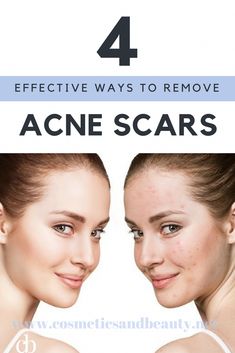 Find out how to get rid of acne scars and fade any scarring quicker with natural, laser therapy and topical treatment methods for different types of acne. Clear Skin Detox, Different Types Of Acne, Forehead Acne, Acne Overnight, Get Rid Of Acne, Rid Of Acne, Types Of Acne