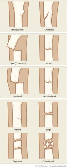 Very informative site on broken bones in kids. (Hope I'm never glad I pinned this) Types Of Fractures, Muzică Rock, Studera Motivation, Bone Fracture, Nursing School Studying, Nursing School Tips, Medical School Studying, Nursing School Notes, Medical Terminology