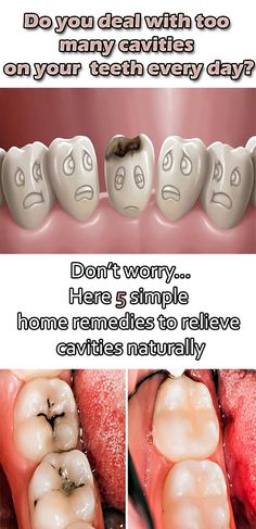 In Today's Time, tooth decay and cavity of teeth are common problems. According to the World Health Organization :- G....
#dentalhealth, #dentalhealthcare Cavity Remedy, Reverse Cavities, Tooth Cavity, Tooth Decay Remedies, Heal Cavities