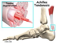 Physiotherapy in Regina, Physiotherapy for Achilles Tendon Problems Foot Health, Emergency Room, Anatomy And Physiology, Warning Signs, Body Health, Chronic Pain, Health Care